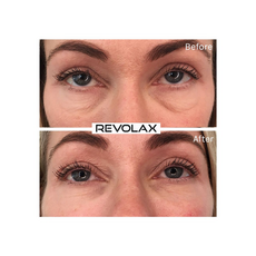 Revolax Fine Lidocaine Acid Hialuronic, image , 4 image