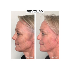 Revolax SUB-Q Lidocaine Acid Hialuronic, image , 5 image