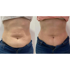 Adipo Plus Acid Hialuronic, image , 7 image