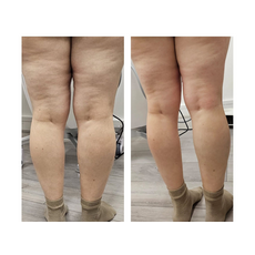 Adipo Plus Acid Hialuronic, image , 6 image