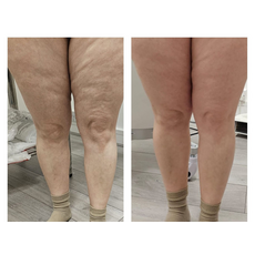 Adipo Plus Acid Hialuronic, image , 5 image