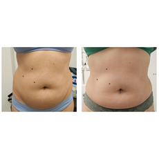 Adipo Plus Acid Hialuronic, image , 8 image