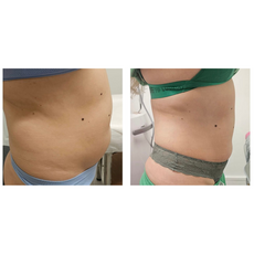 Adipo Plus Acid Hialuronic, image , 9 image