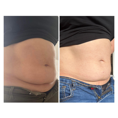 Adipo Plus Acid Hialuronic, image , 4 image