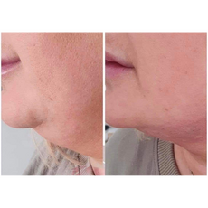 Adipo Plus Acid Hialuronic, image , 3 image