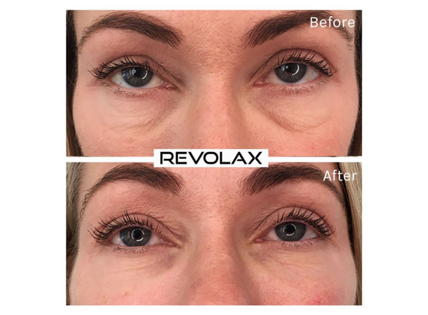 Revolax SUB-Q Lidocaine Acid Hialuronic, image , 4 image