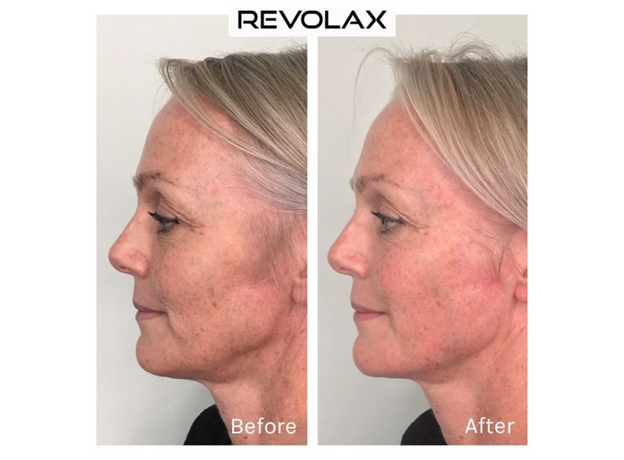 Revolax Fine Lidocaine Acid Hialuronic, image , 5 image