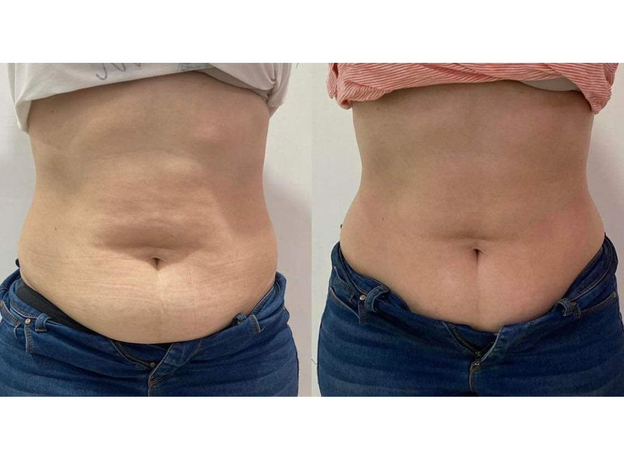 Adipo Plus Acid Hialuronic, image , 7 image