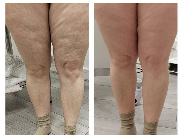 Adipo Plus Acid Hialuronic, image , 5 image