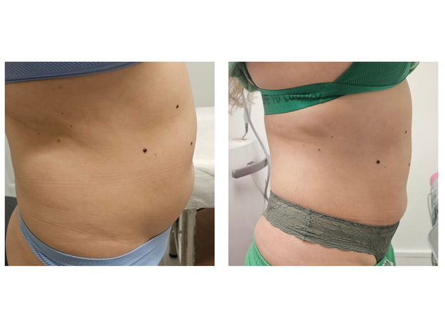 Adipo Plus Acid Hialuronic, image , 9 image