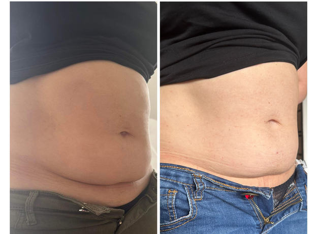 Adipo Plus Acid Hialuronic, image , 4 image