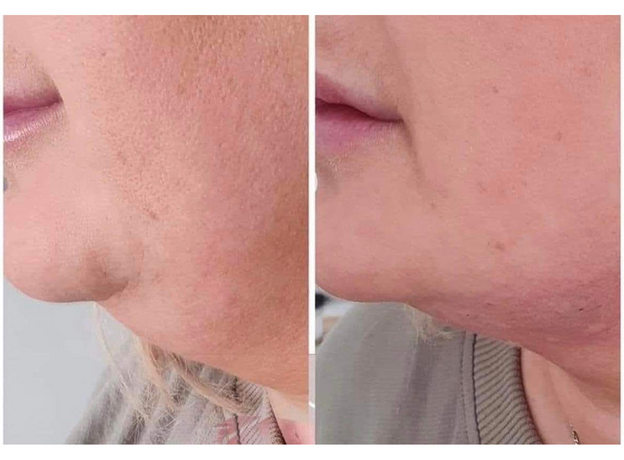 Adipo Plus Acid Hialuronic, image , 3 image